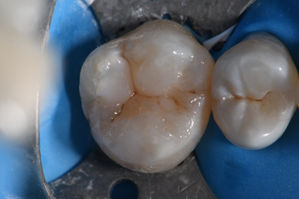 Composite Fillings Marginal Leakage and Failure Composite Fillings