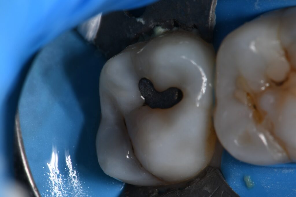 Ceram X Spectra ST Composite