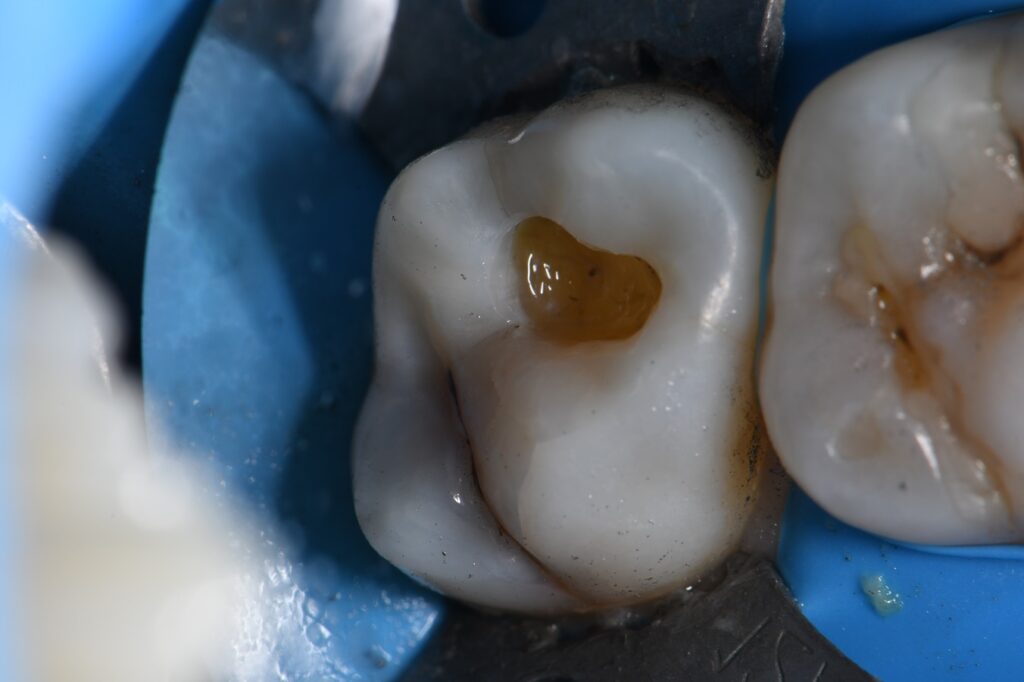 Ceram X Spectra ST Composite