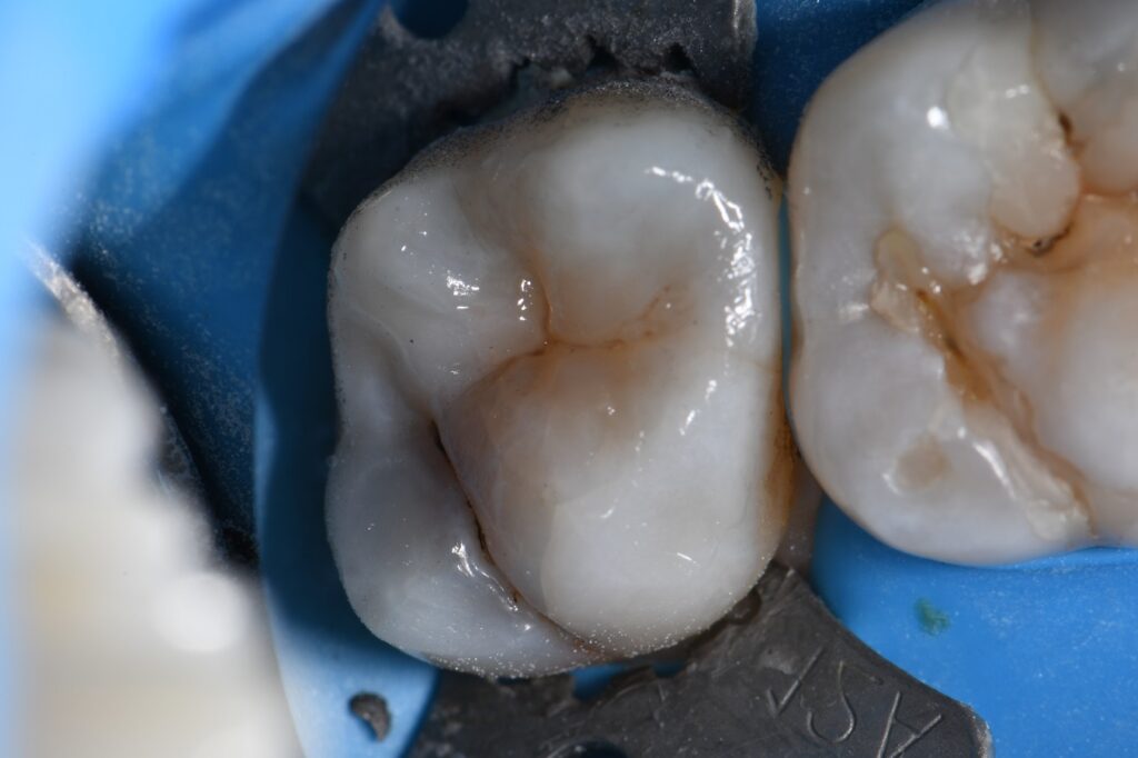 Ceram X Spectra ST Composite