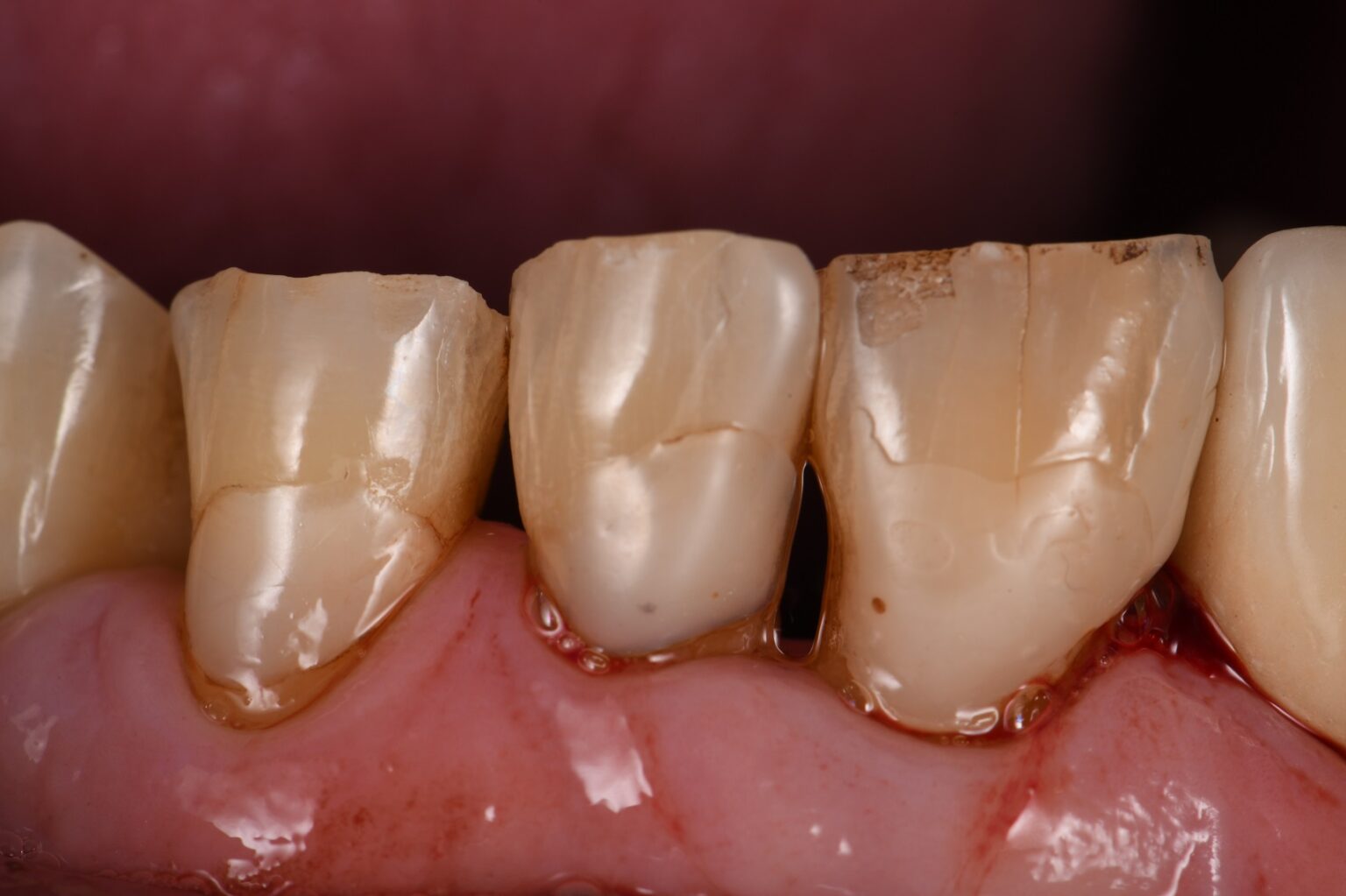Large direct restorations on abrasion lesions Large direct restorations