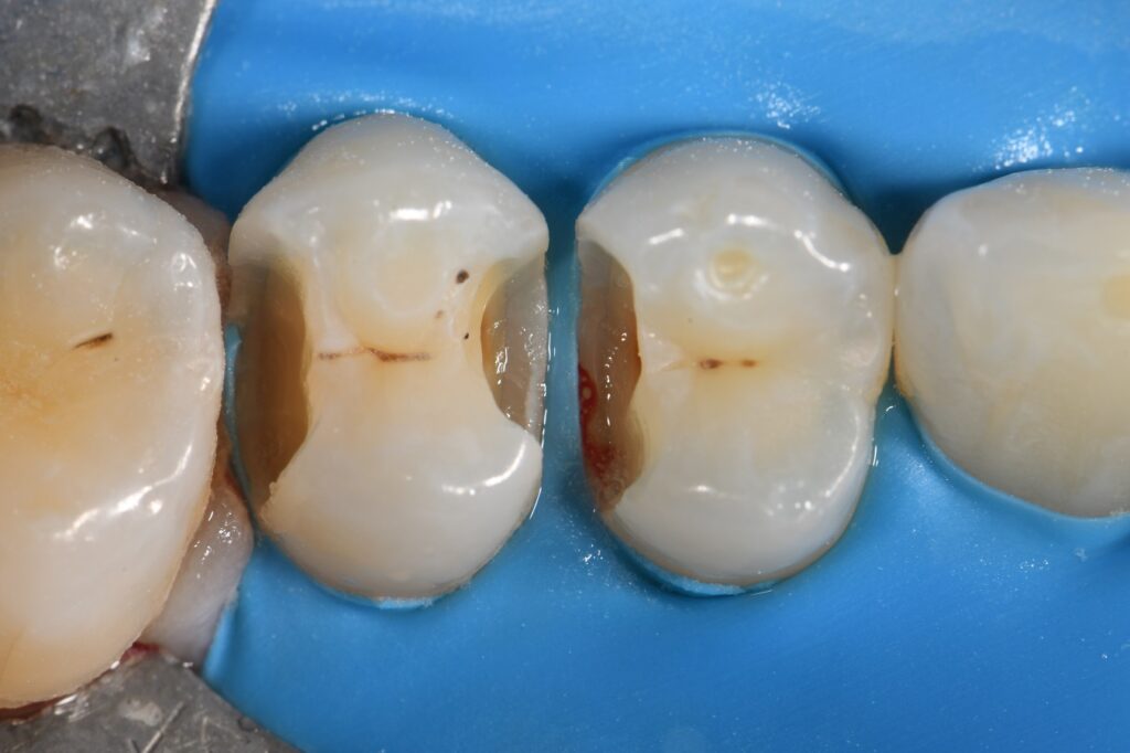 Kuraray Majesty ES 2 Universal Composite Resin Kuraray Majesty ES 2