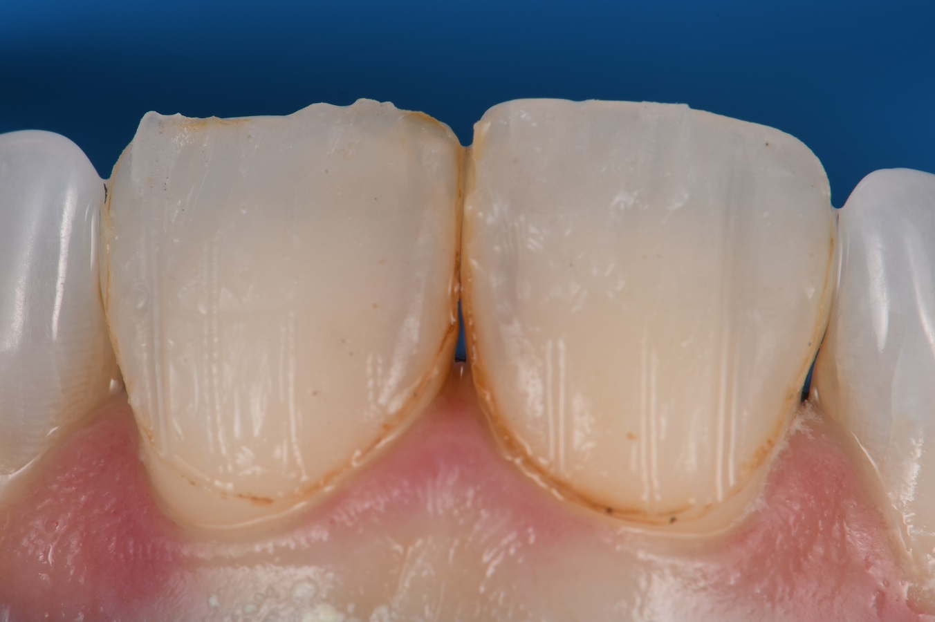 Porcelain Veneer Replacement with Composite Veneers Porcelain Veneer ...