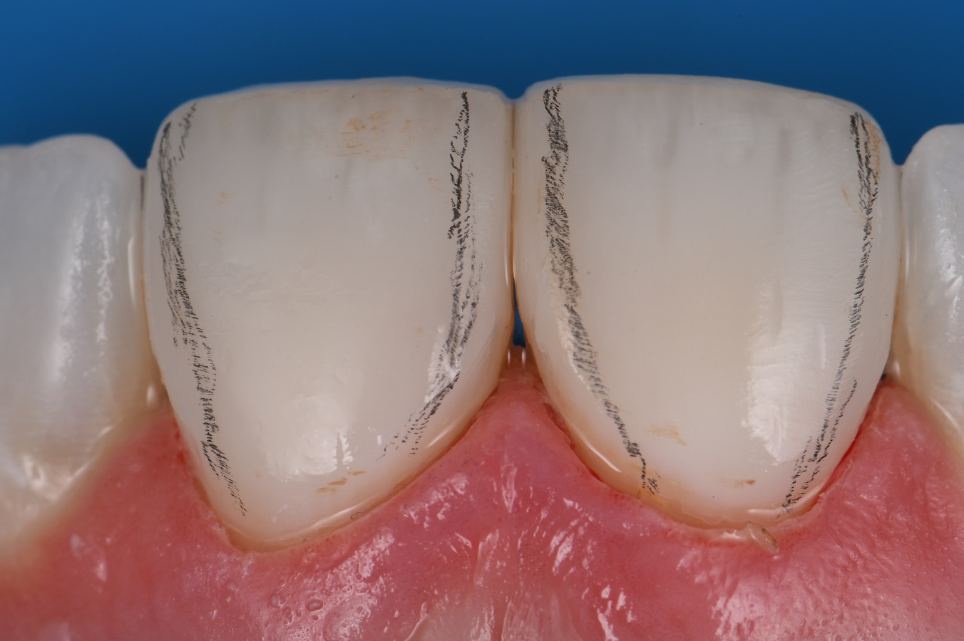 Porcelain Veneer Replacement with Composite Veneers Porcelain Veneer ... - Marble To Porcelain Veneer Conversion
