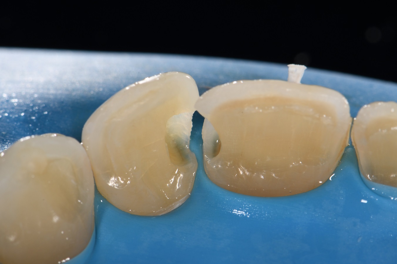 Class III composite restorations Class III composite restorations