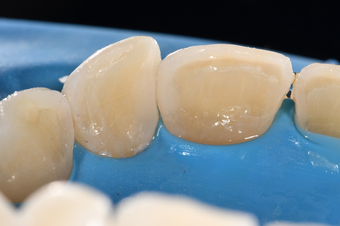 Class III composite restorations Class III composite restorations