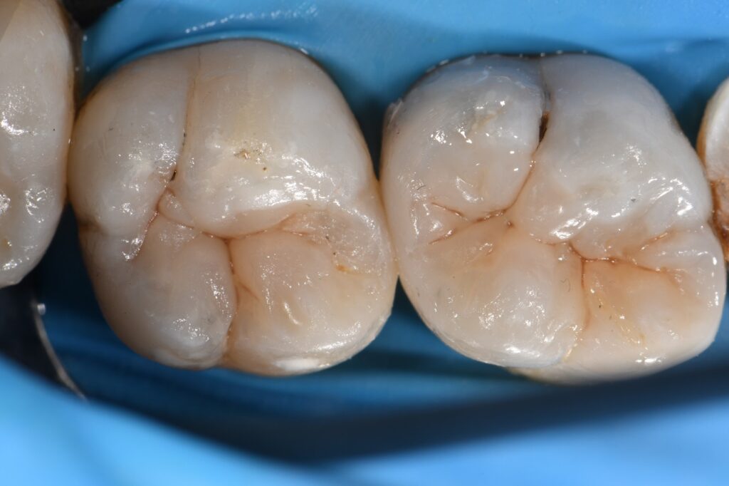 Removing Cracks and Amalgam in Teeth Removing Cracks and Amalgam in Teeth