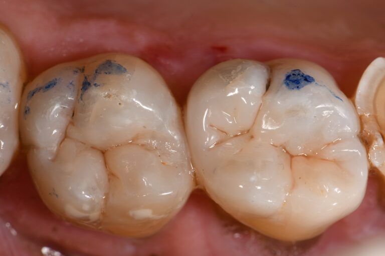 Removing Cracks and Amalgam in Teeth Removing Cracks and Amalgam in Teeth