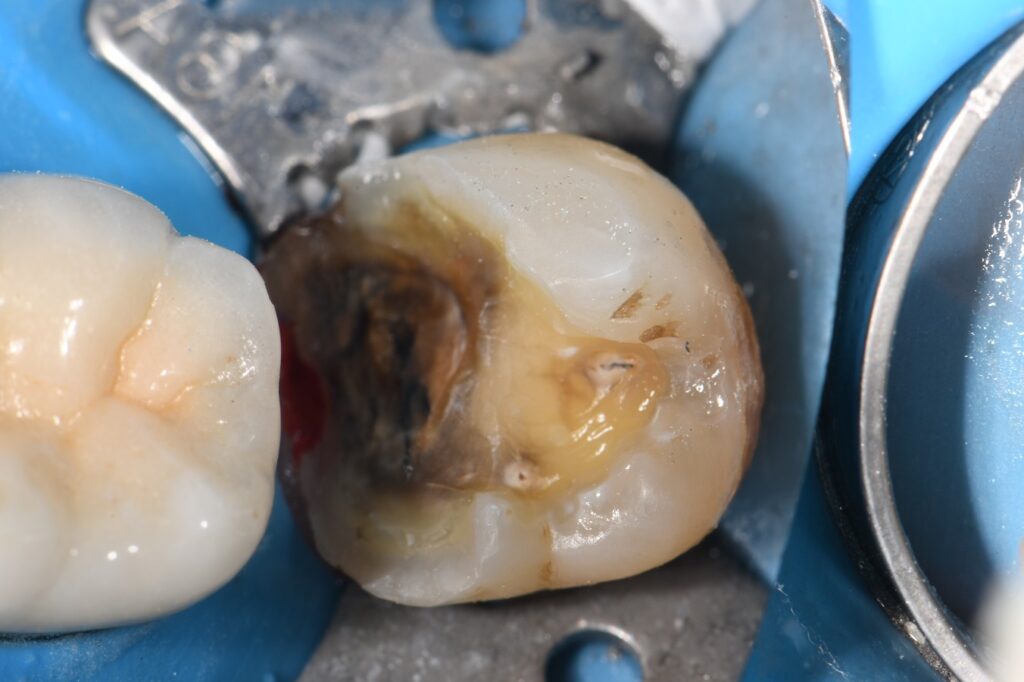 Garrison Dental Wide Prep Ring Garrison Dental Wide Prep Ring