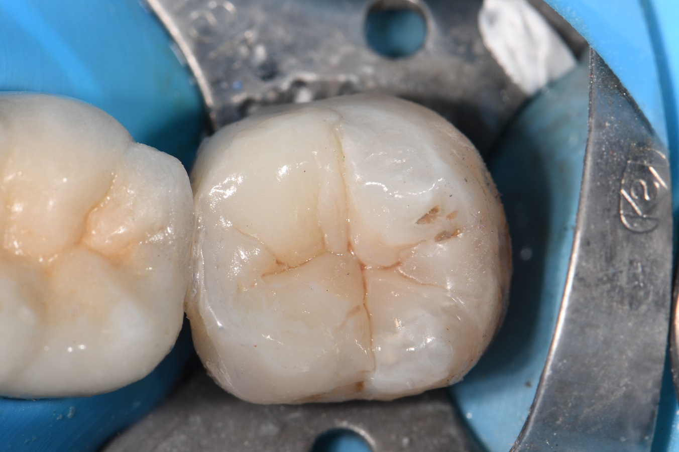 Garrison Dental Wide Prep Ring Garrison Dental Wide Prep Ring