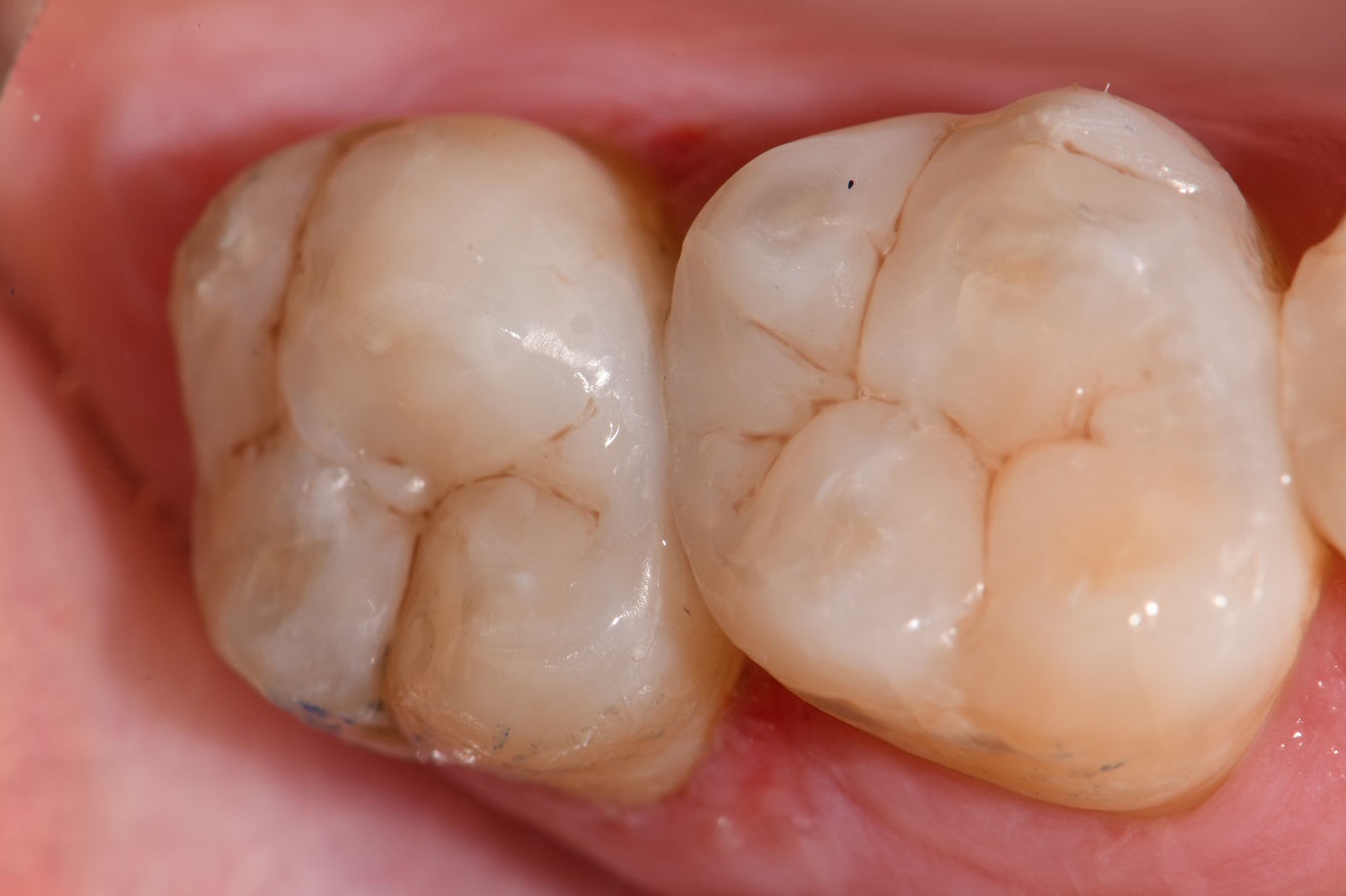 Dental Amalgam Replacements with Composite