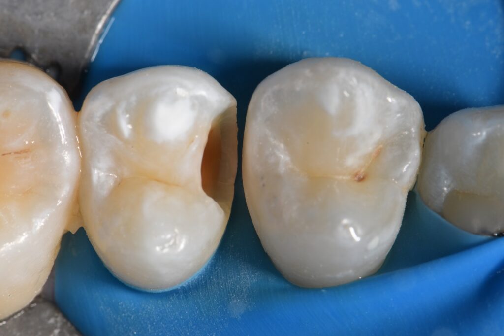 Slot restorations back to back Slot restorations back to back