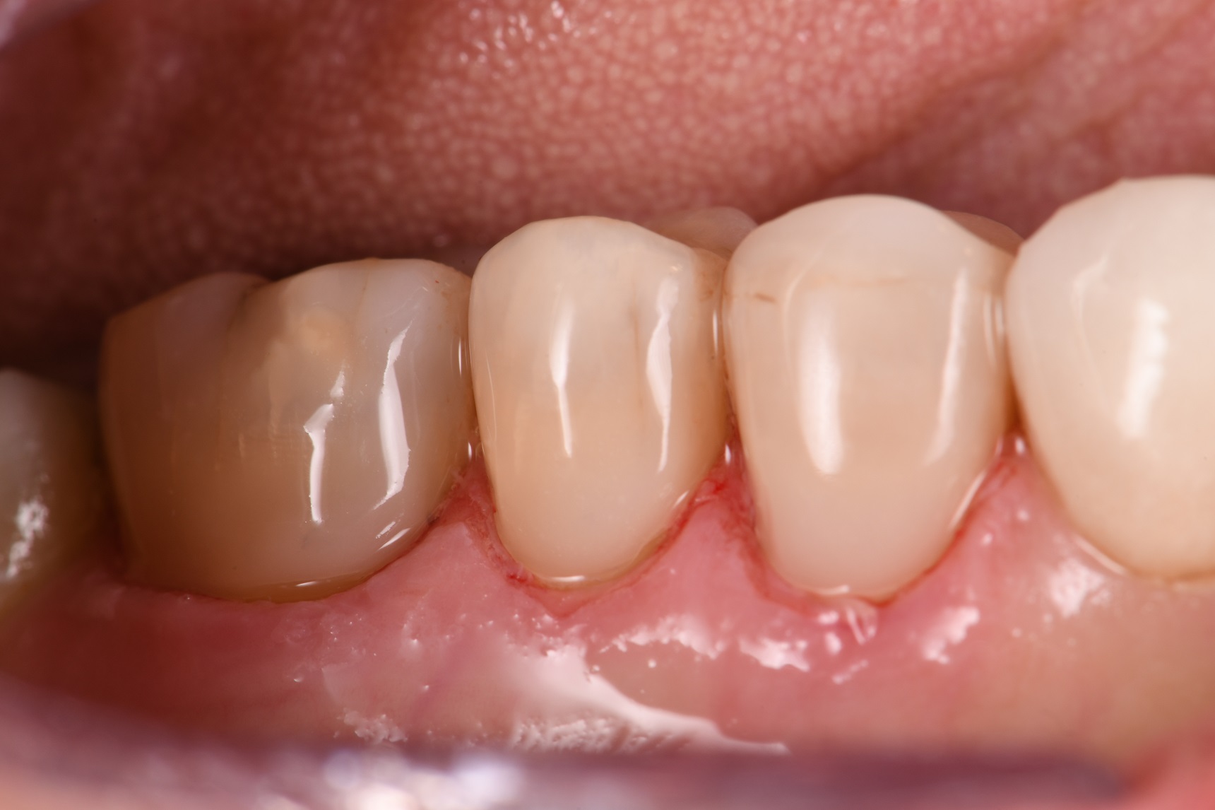 Deep Cervical Abrasion Deep Cervical Abrasion