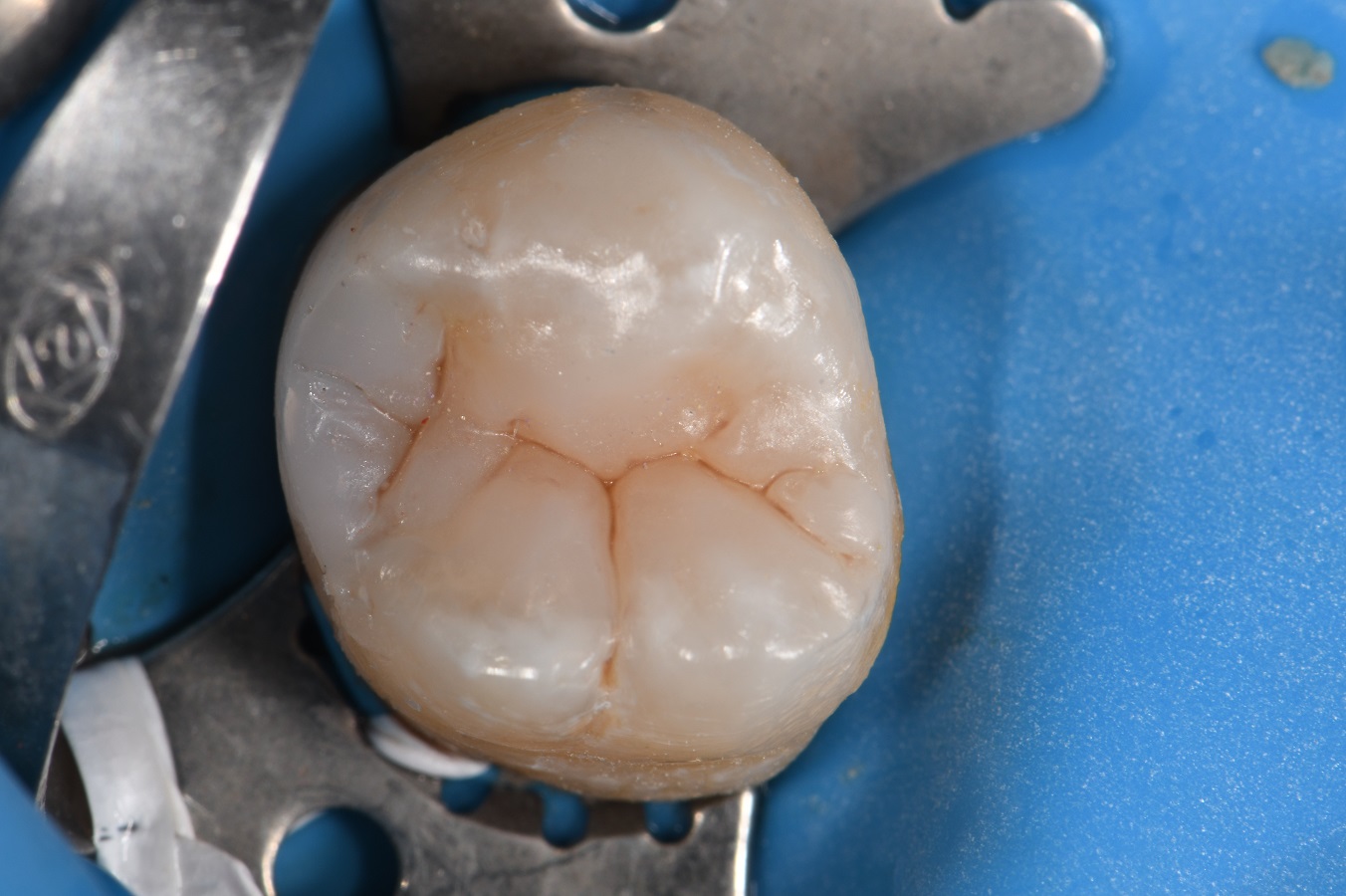 Anatomically Contoured Composite Resin Anatomically Contoured Composite