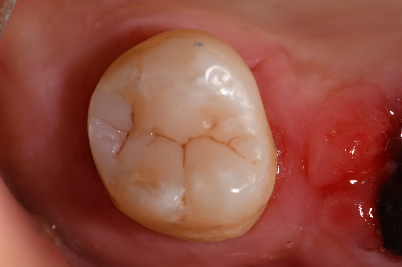 Anatomically Contoured Composite Resin Anatomically Contoured Composite