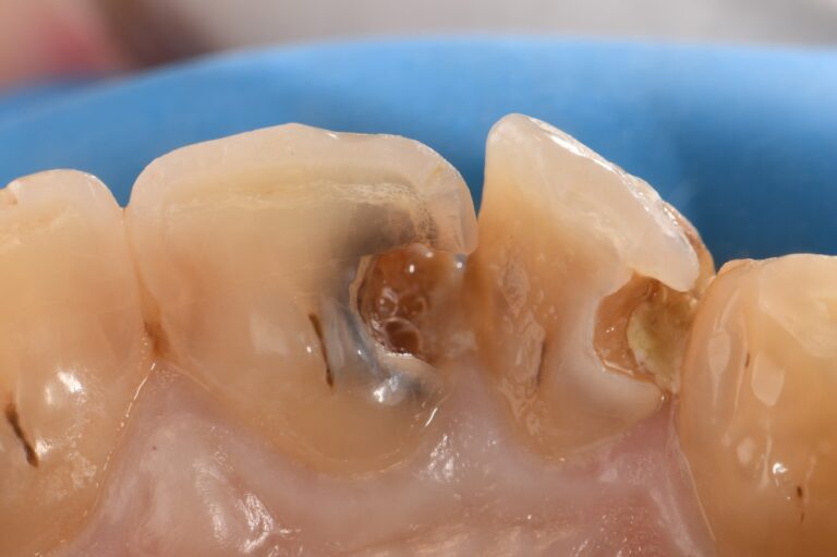 Rampant Caries Breakdown Restored with Composite Resin