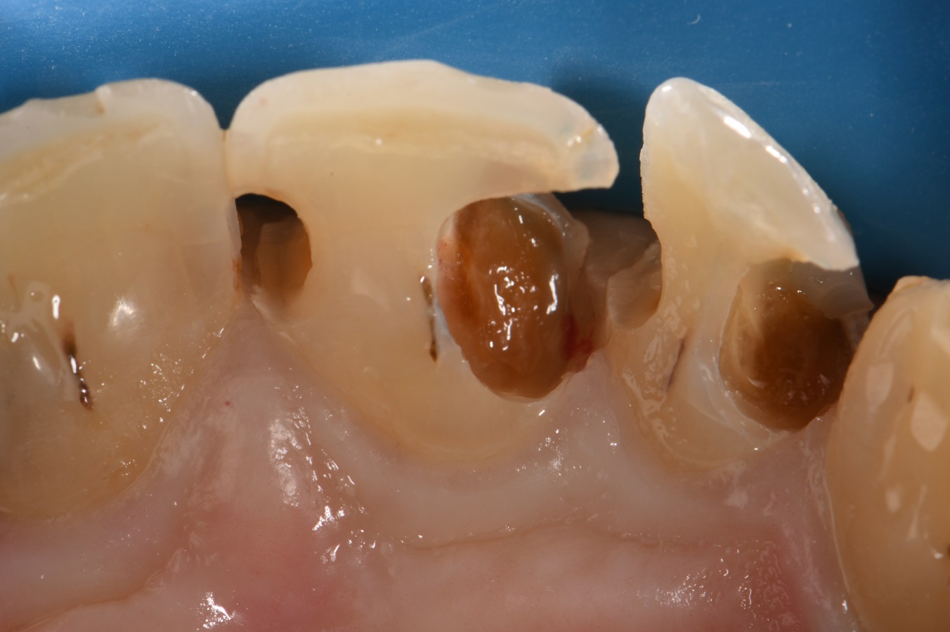 Rampant Caries Breakdown Restored with Composite Resin