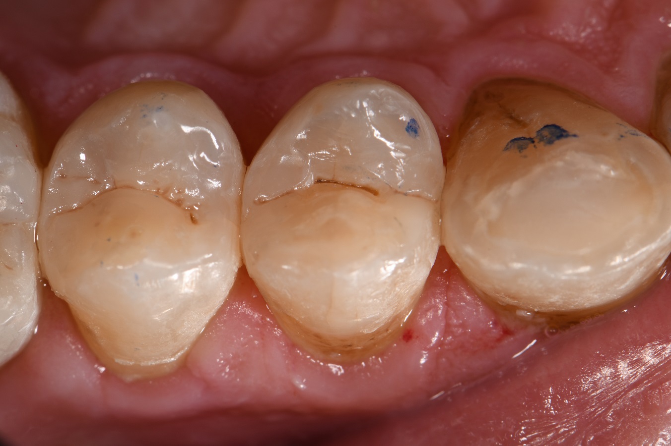 Chameleon Composite Resin Restorations Chameleon Composite Resin Restorations