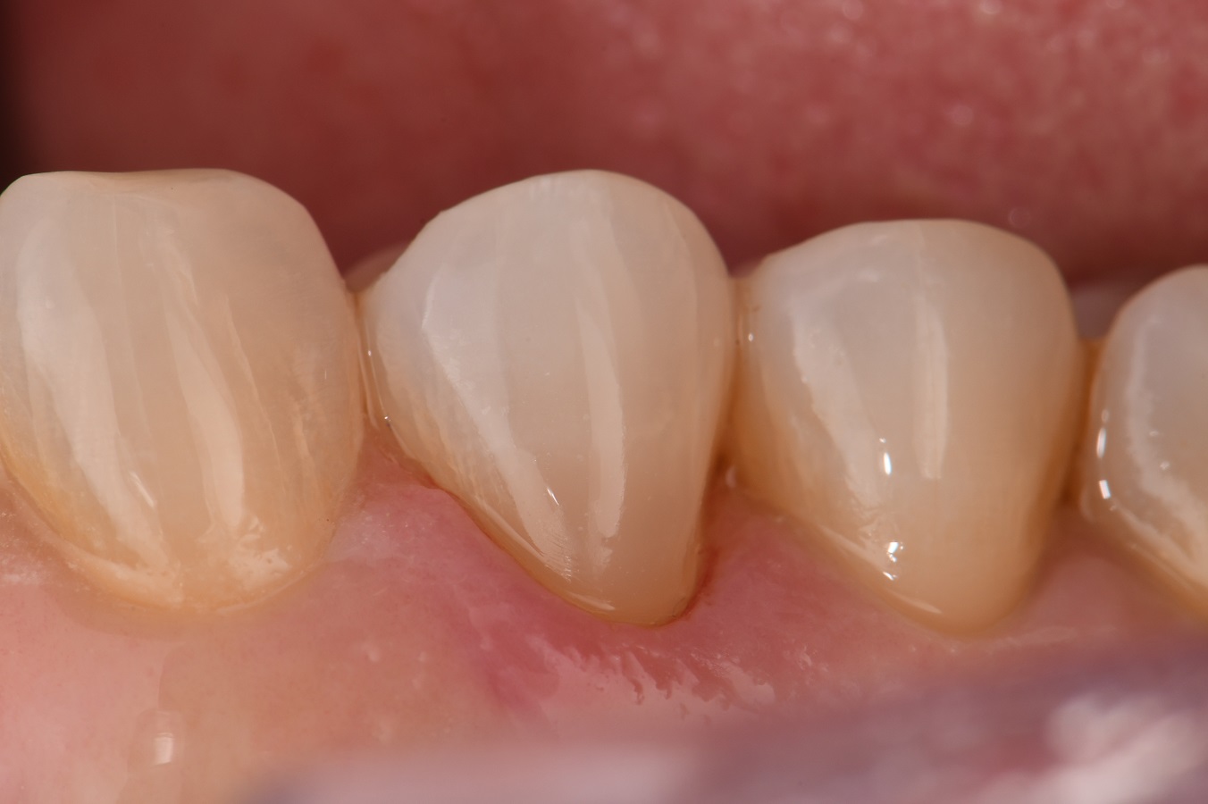 Class V seamless restoration Class V seamless restoration