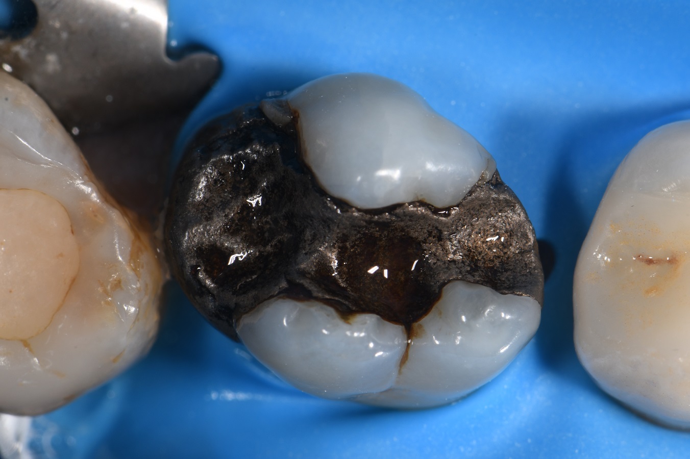 Dental Crown Indirect Restoration Workflow