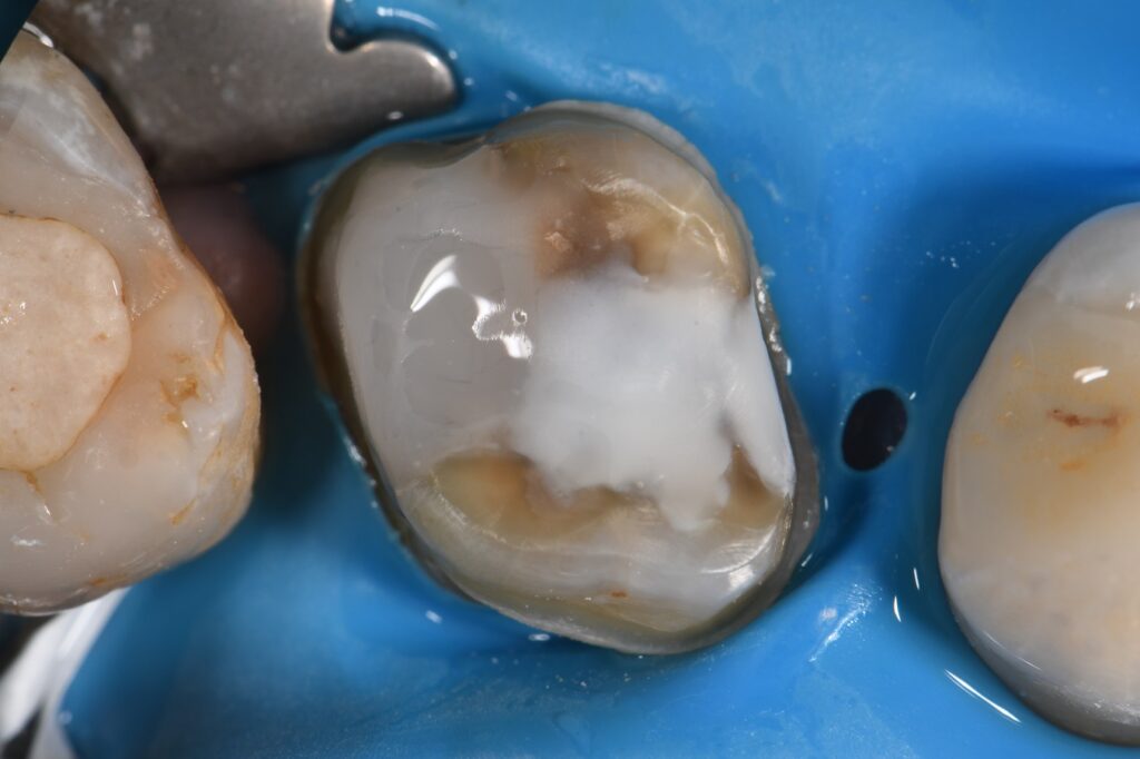 Dental Crown Indirect Restoration Workflow