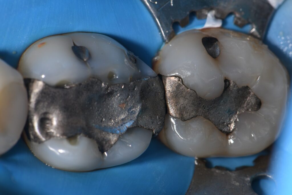 Extensive Amalgam Replacements with Composite