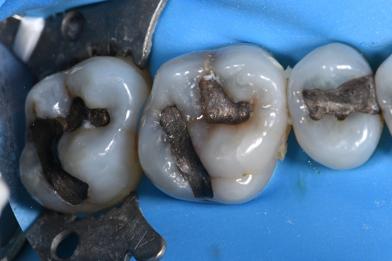 Complex Composite Resin Complex Composite Resin