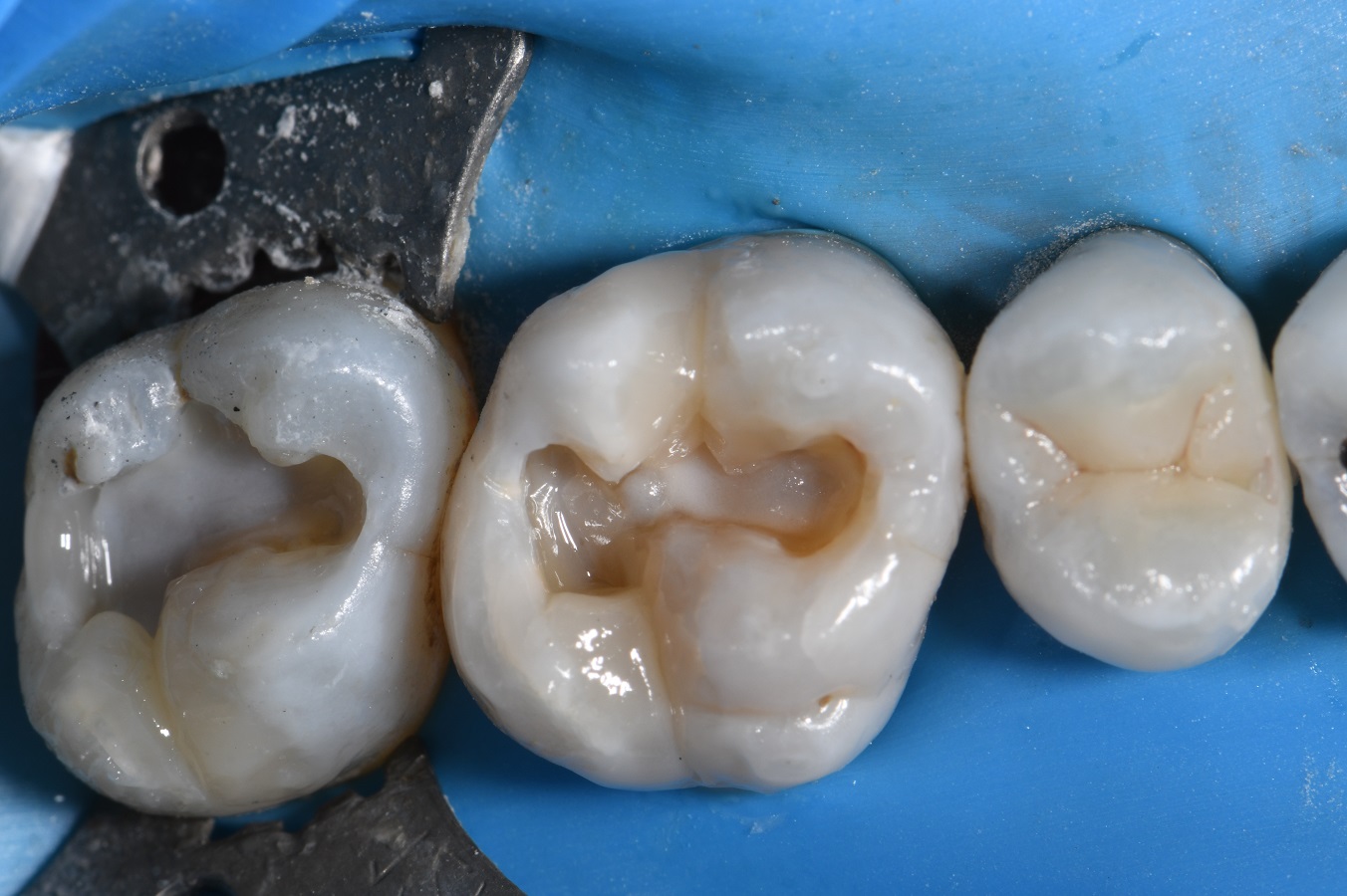 Complex Composite Resin Complex Composite Resin