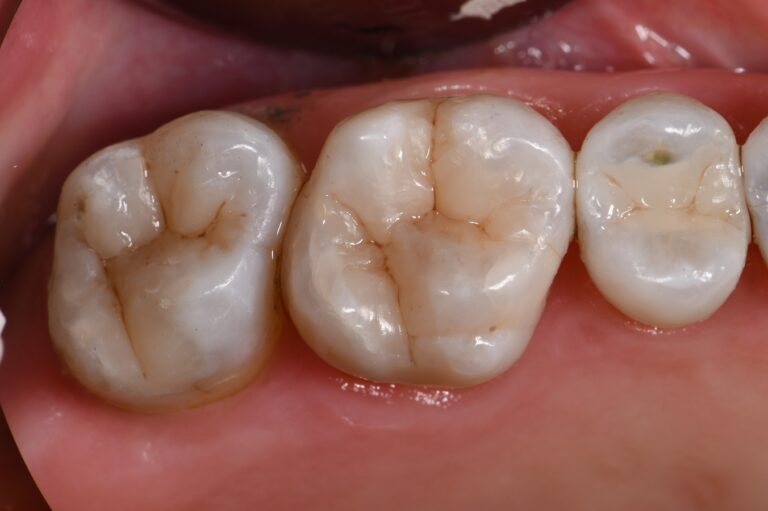 Complex Composite Resin Complex Composite Resin