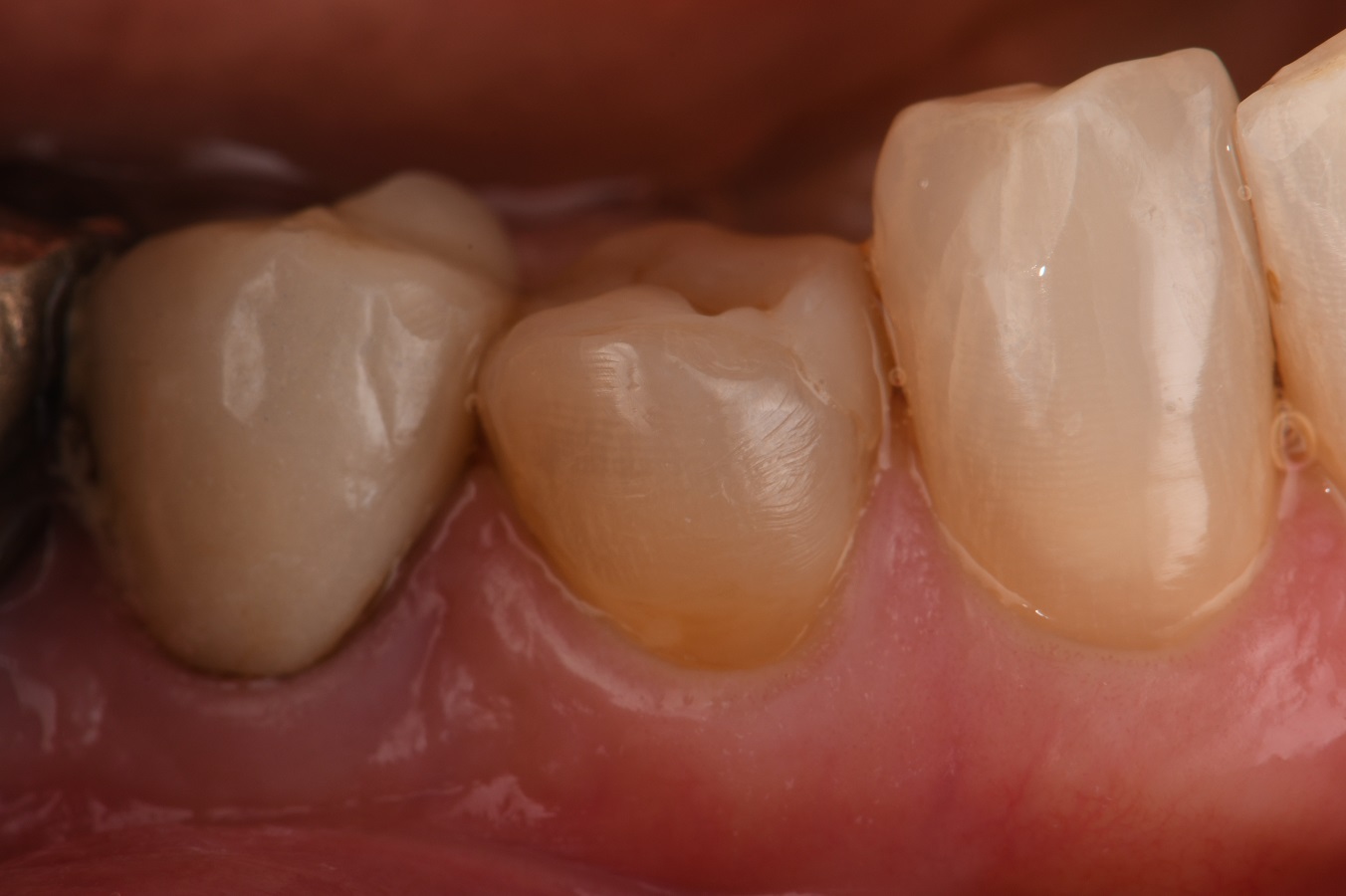 Routine Class V restorations