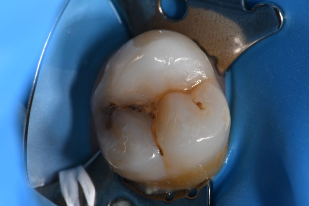 Class I dental cavity restored Class I dental cavity restored