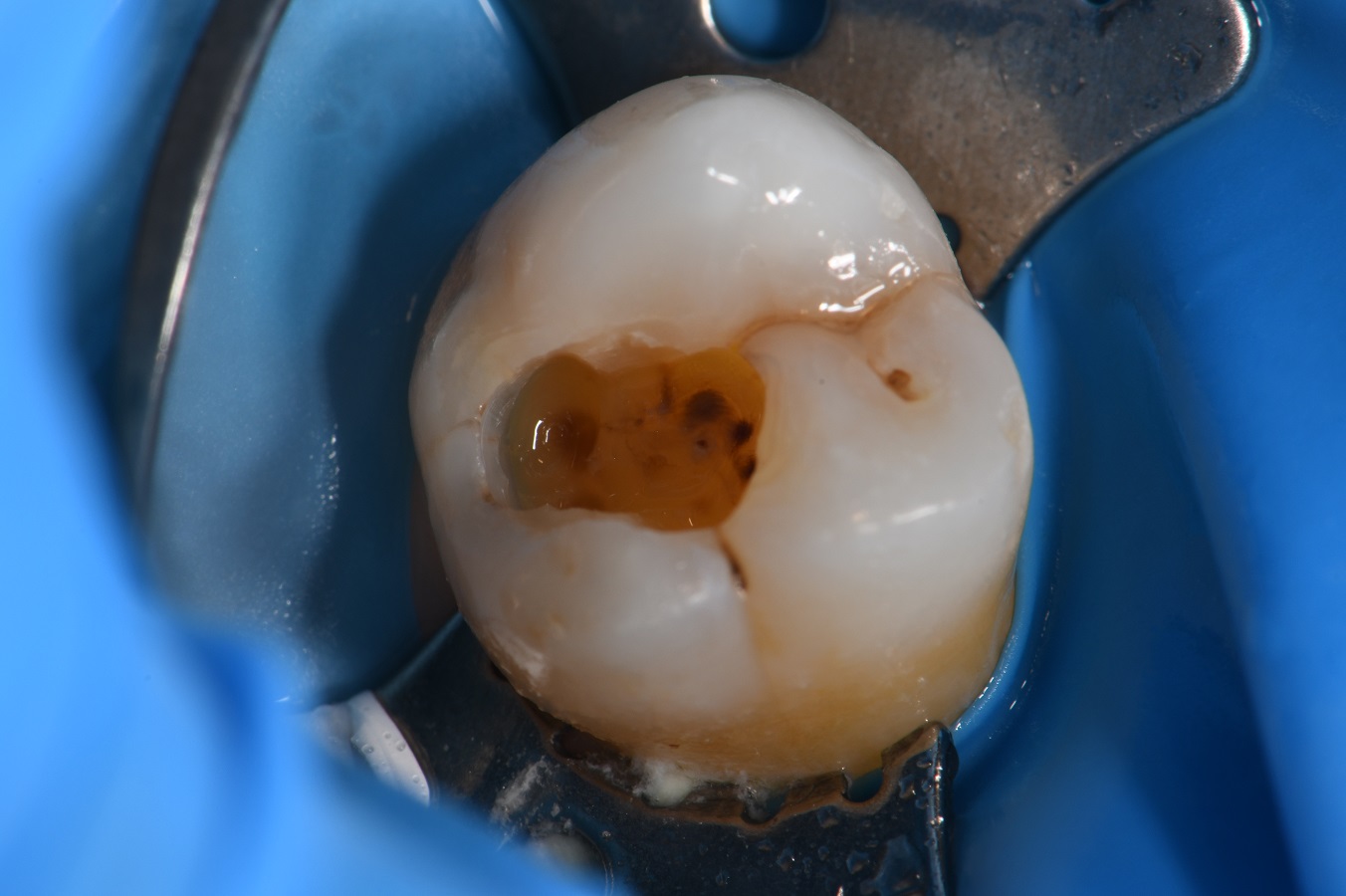 Class I dental cavity restored Class I dental cavity restored