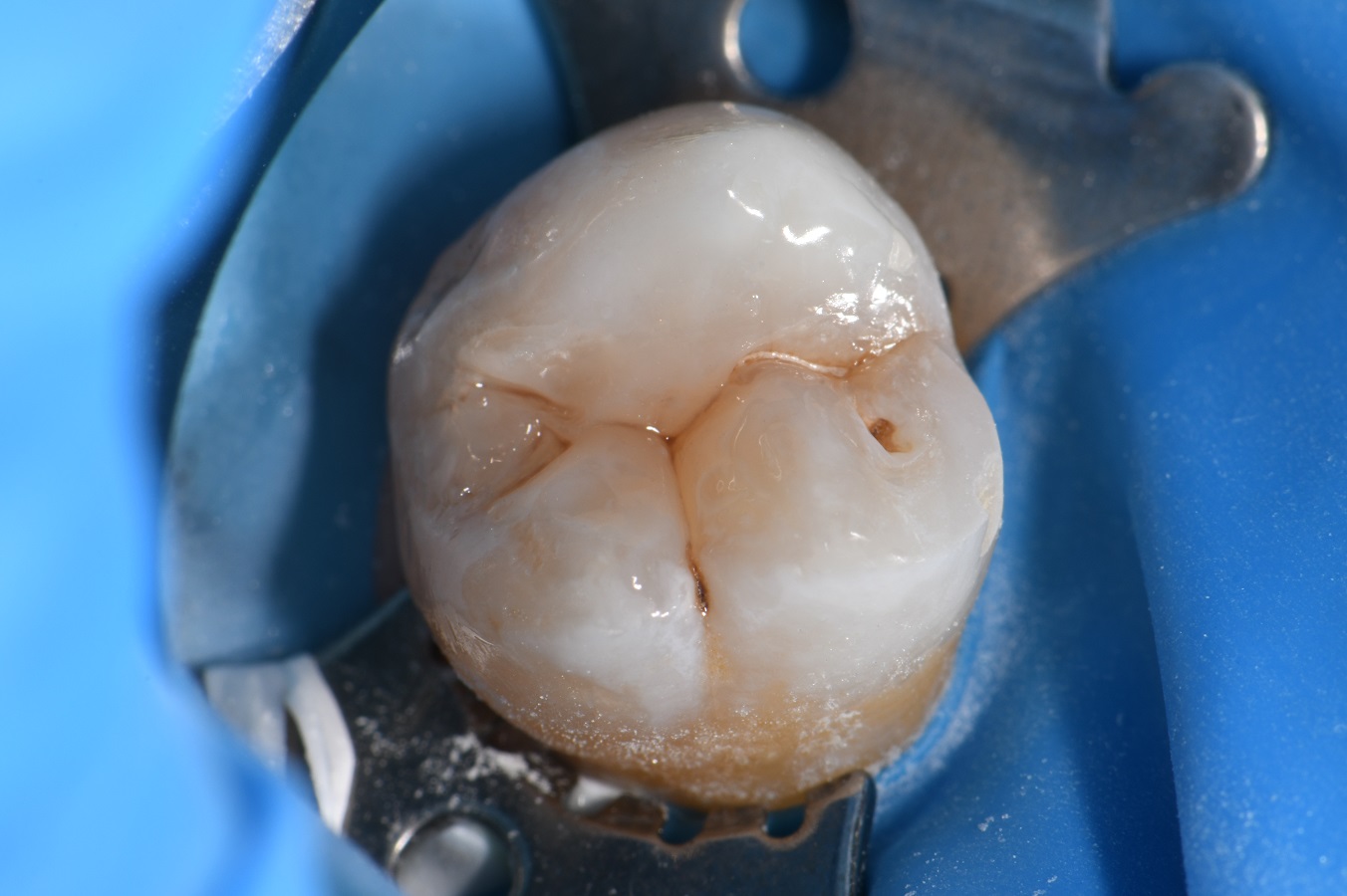 Class I dental cavity restored Class I dental cavity restored