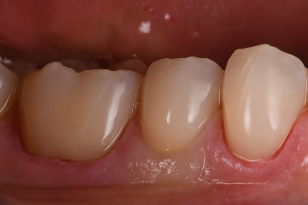 Cervical Abrasion Lesions Under the Gum Cervical Abrasion Lesions Under