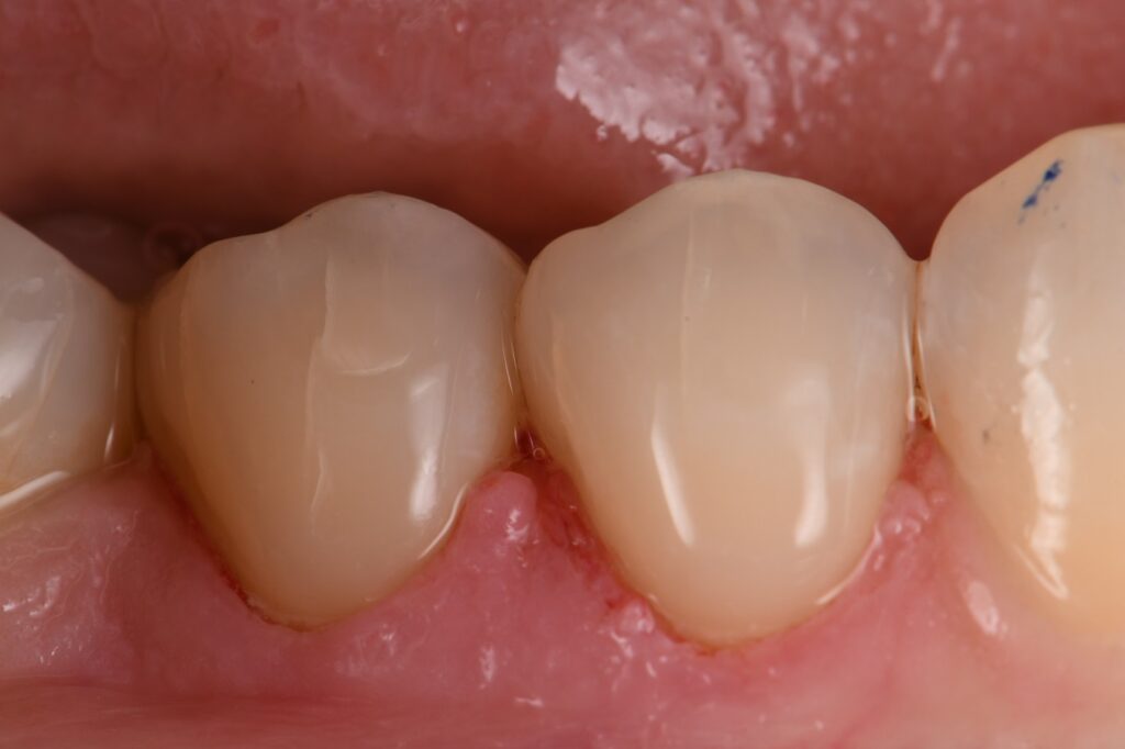 Toothbrush Scrubbing Damage Toothbrush Scrubbing Damage