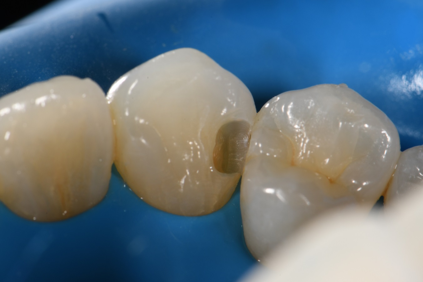 Direct Restorations for Discerning Dentists Direct Restorations for