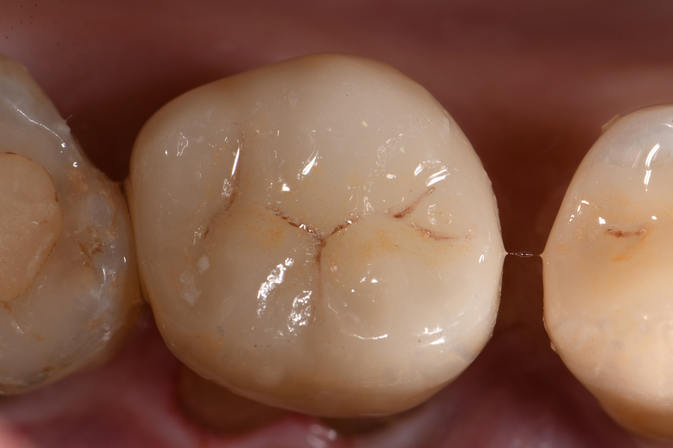 Dental Crown Indirect Restoration Workflow