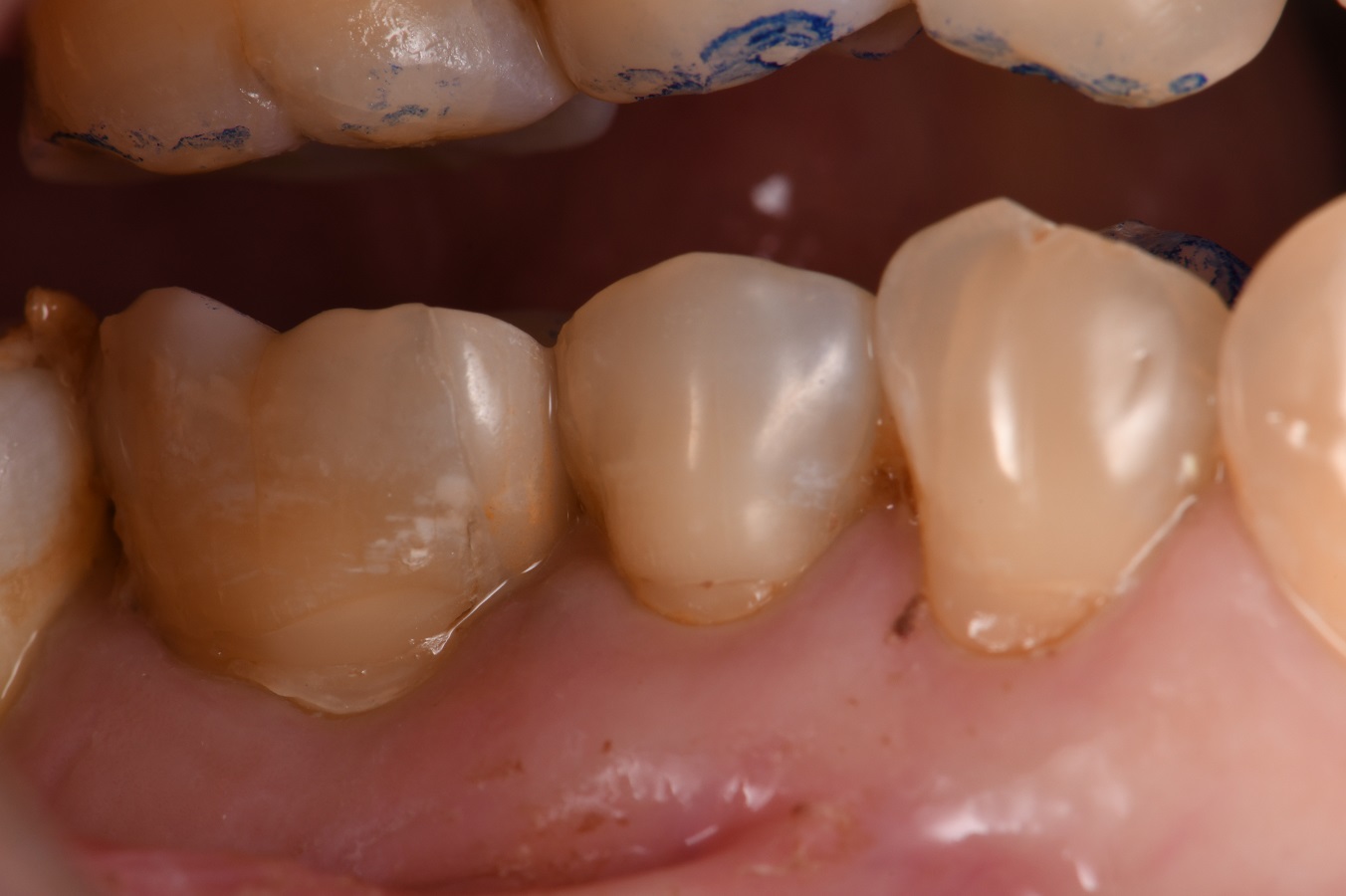 Cervical Abrasion Lesions GCEssentiaU