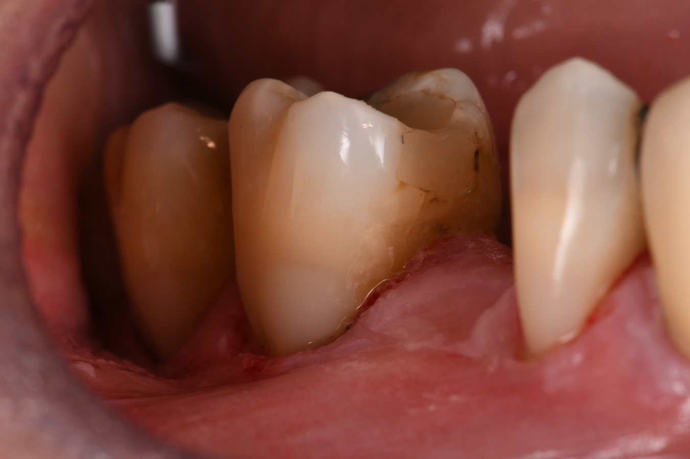 Pre bleaching composite restoration shade Pre bleaching composite