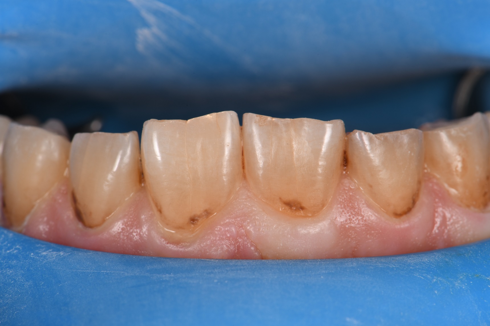 Occult Dental Caries Occult Dental Caries