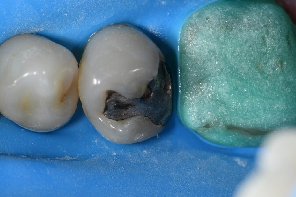 Matrix in Matrix Composite Resin Technique