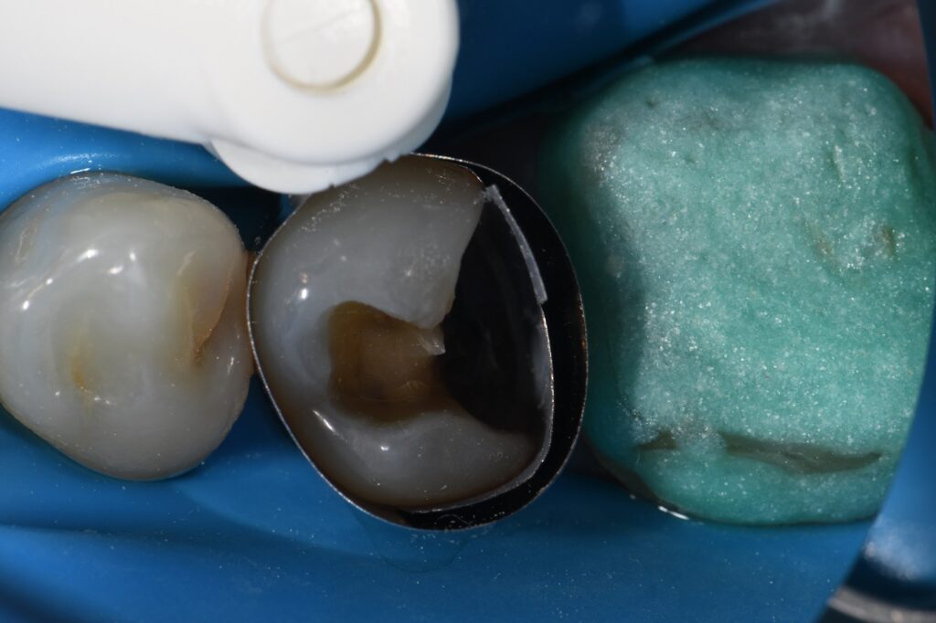 Matrix in Matrix Composite Resin Technique