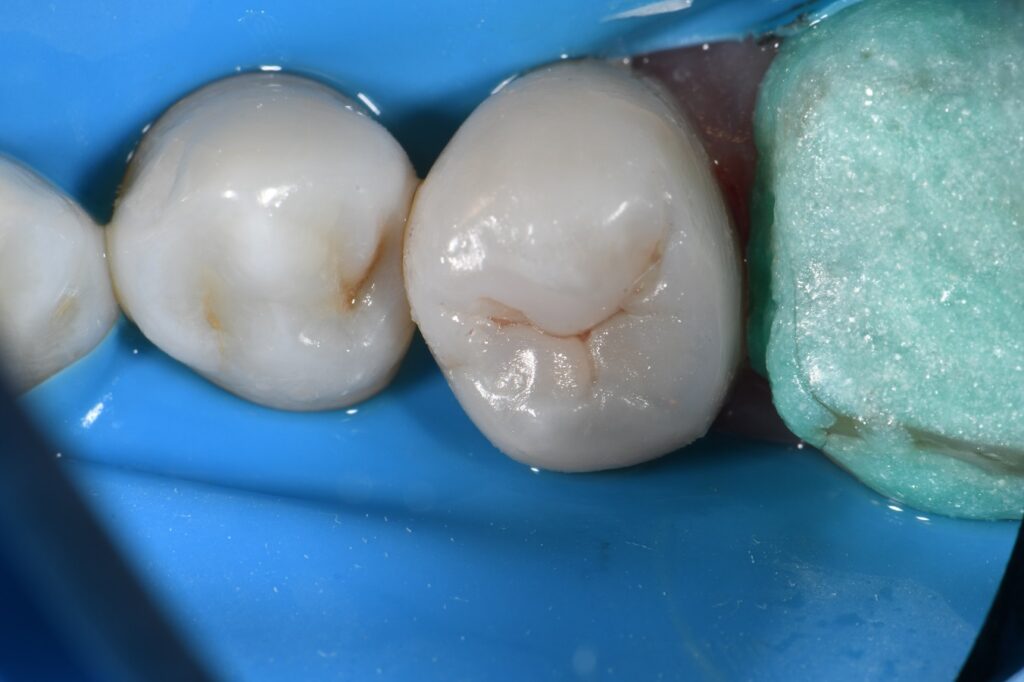 Matrix in Matrix Composite Resin Technique