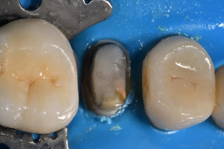 Reinforcing old Crowned Teeth Reinforcing old Crowned Teeth