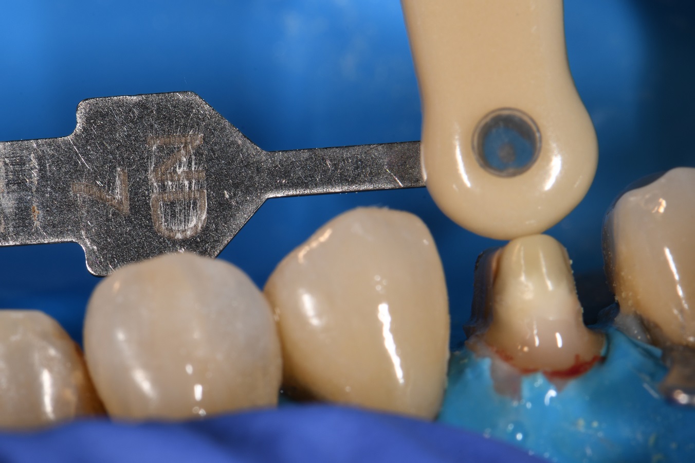 Reinforcing old Crowned Teeth Reinforcing old Crowned Teeth