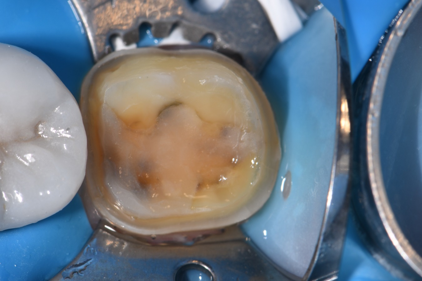 Bonded Dental Crowns