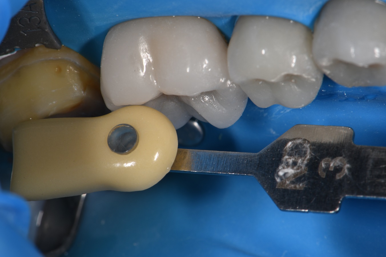Bonded Dental Crowns