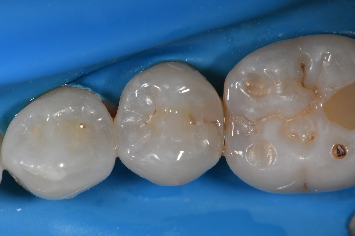 Conservative Slot Composite Restoration Conservative Slot Composite