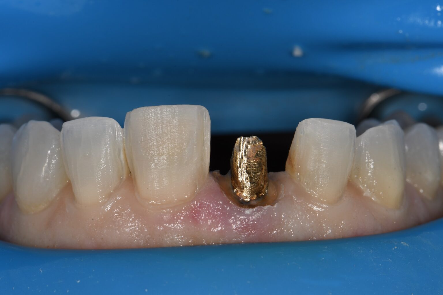 Blocking out Metal Cores under Crowns Blocking out Metal Cores under Crowns