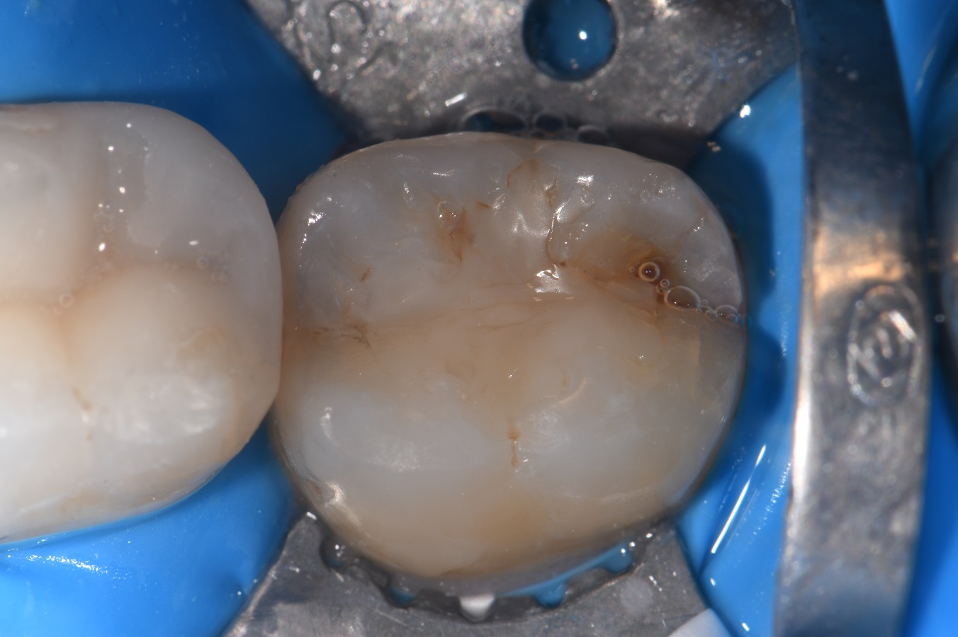 Chasing Cracks in Heavily Restored Teeth Chasing Cracks in Heavily ...